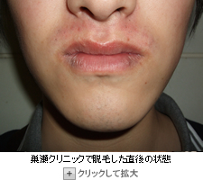 巣瀬クリニックでヒゲ脱毛（鼻下）体験後の写真