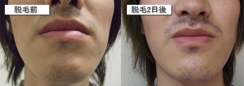 神奈川クリニックでヒゲの医療レーザー脱毛をする前とした2日後の写真