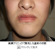 巣瀬クリニックで脱毛する直前の状態