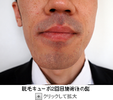 脱毛キューボで２回目ヒゲ脱毛前の写真