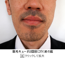 脱毛キューボで２回目ヒゲ脱毛前の写真