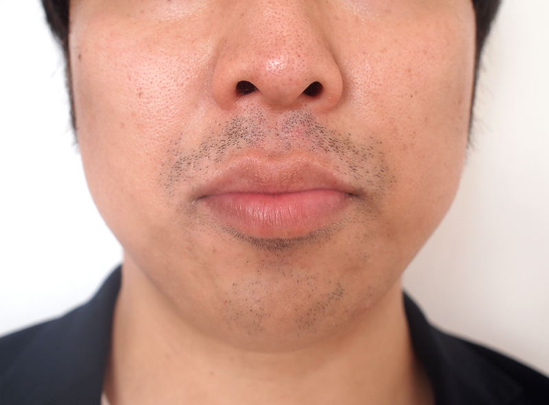 ゴリラクリニックで19回目の髭脱毛前の写真
