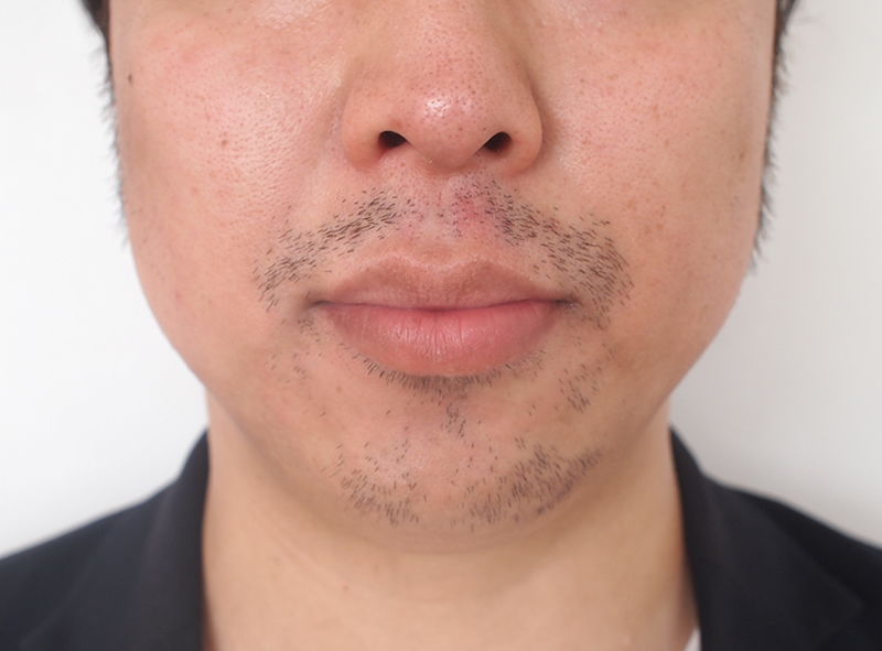 ゴリラクリニックで20回目の髭脱毛前の写真