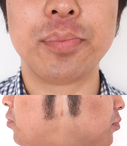 ゴリラクリニックで16回目の髭脱毛後、約1時間後の写真