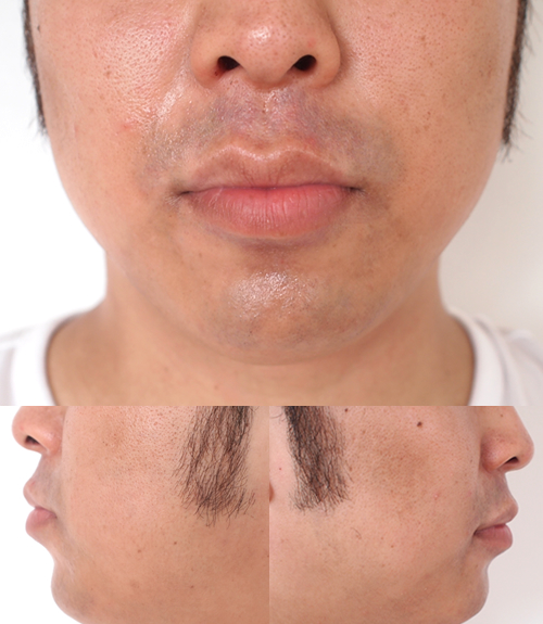 ゴリラクリニックで17回目の髭脱毛後、約1時間後の写真