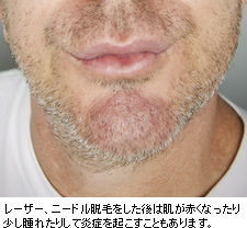 レーザー、ニードル脱毛をした後は肌が赤くなったり少し腫れたりして炎症を起こすこともあります。