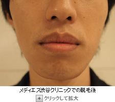 メディエス渋谷クリニックでヒゲ脱毛（顔全体）体験後の写真