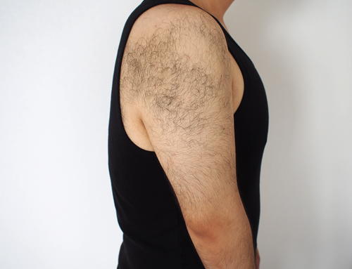 リンクス腕から肘の脱毛経過写真