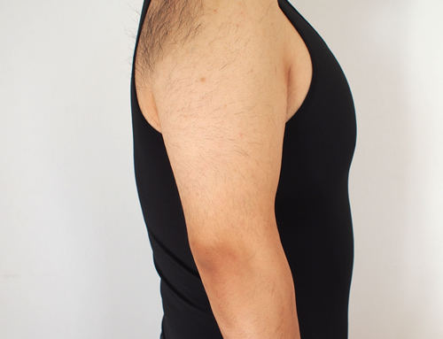 リンクス腕から肘の脱毛経過写真2回目