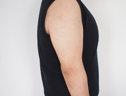 リンクス腕から肘の脱毛経過写真3回目