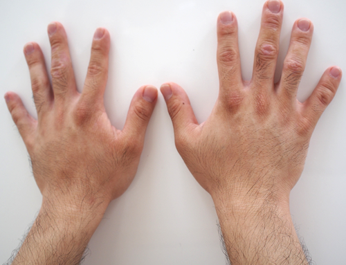 リンクスの脱毛手の甲と指の経過写真