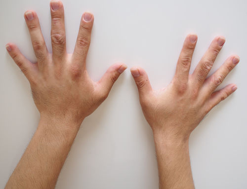 リンクスの脱毛手の甲と指の経過写真