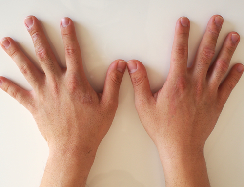 リンクスの脱毛手の甲と指の経過写真