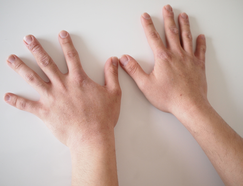 リンクスの脱毛手の甲と指の経過写真