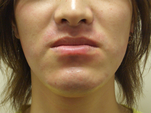 アレキサンドライトレーザーで脱毛後